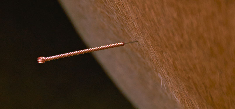 An acupuncture needle is provoking a stimulus inside the body